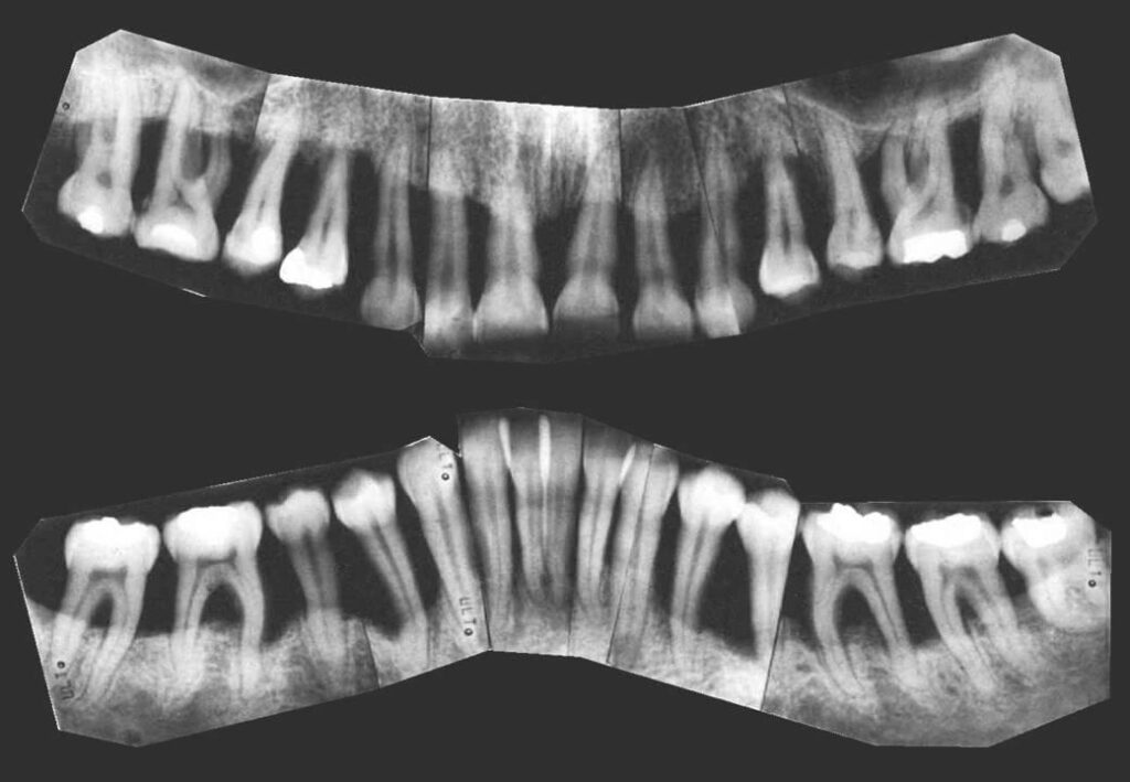 Röntgenstatus einer Patientin mit Parodontitis